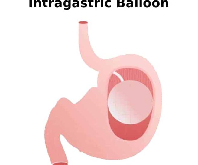 Intragastric Balloon